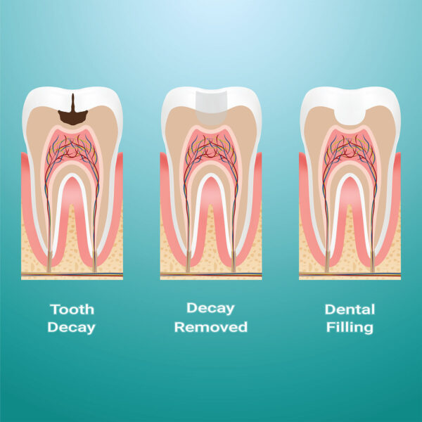 dental instruments for dealing with cavities